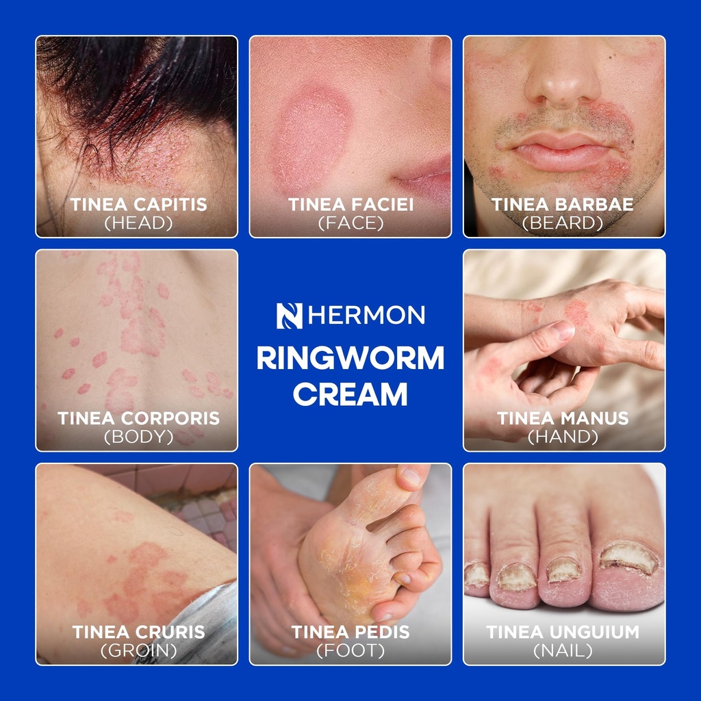 hermon-antifungal-ringworm-cream-for-hum-3.jpg