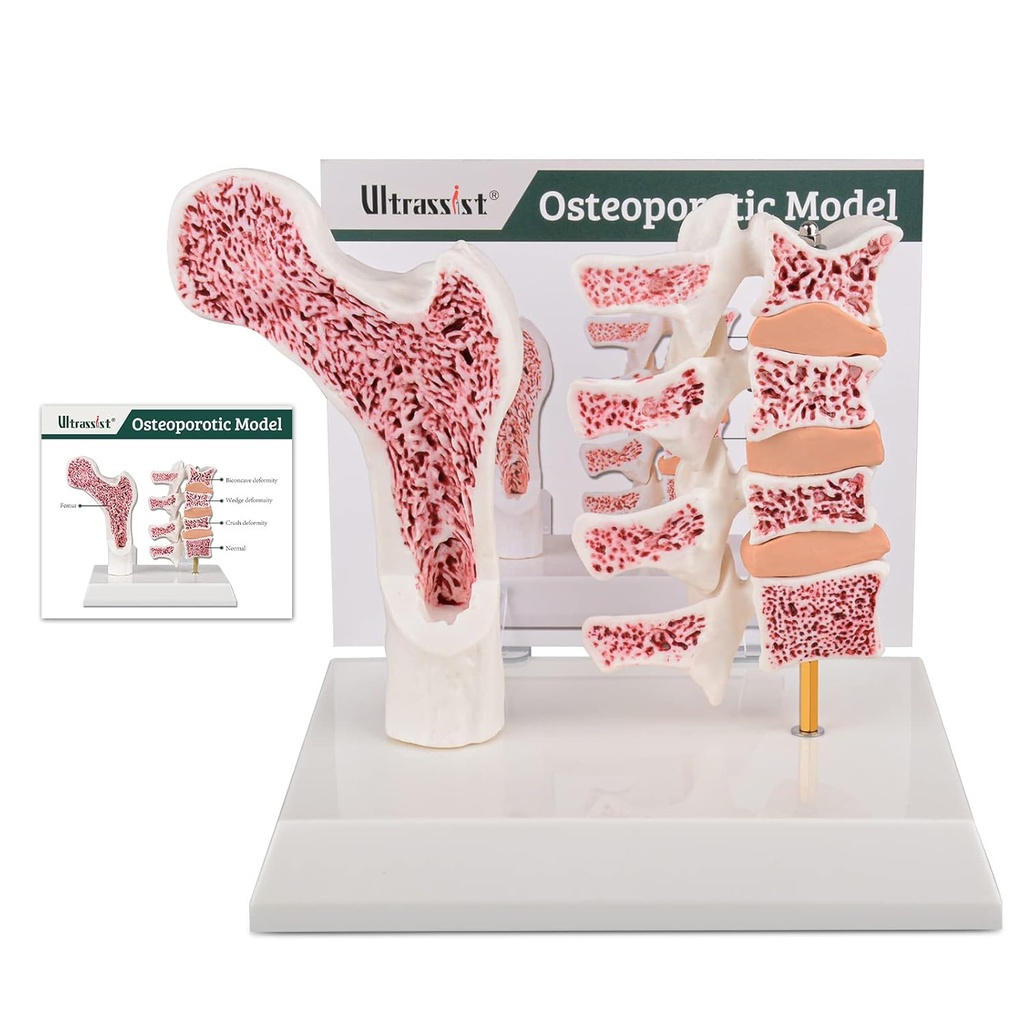 Model Ultrassist Human Anatomi Osteoporosis, Vertebrae Anatomical Skeleton Model dengan Studi Card for Medical Student Mengajar Demonstrasi